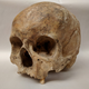 Skeletal remains showing evidence of leprosy from the Odense St. Jørgen cemetery in Denmark, which was established in 1270 and existed until 1560.